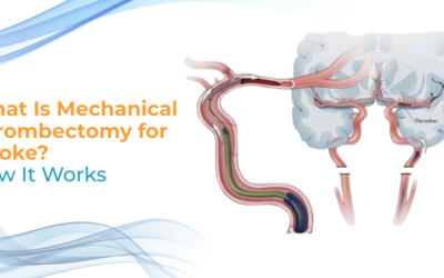 What Is Mechanical Thrombectomy for Stroke?