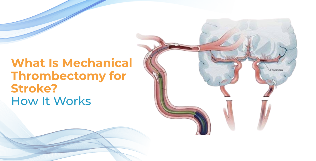 What Is Mechanical Thrombectomy for Stroke?