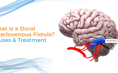 What Is a Dural Arteriovenous Fistula?