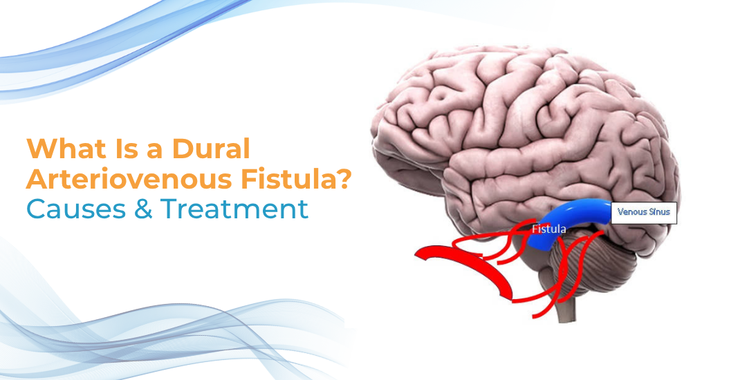 What Is a Dural Arteriovenous Fistula?